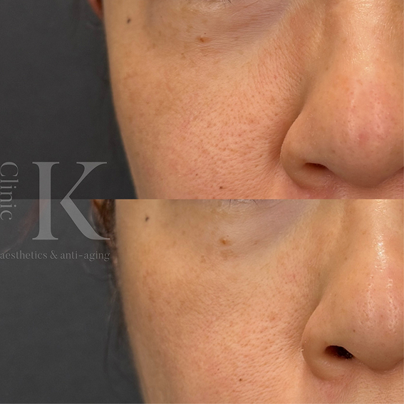 BLESSING(ブレッシング)で期待できる効果とは？