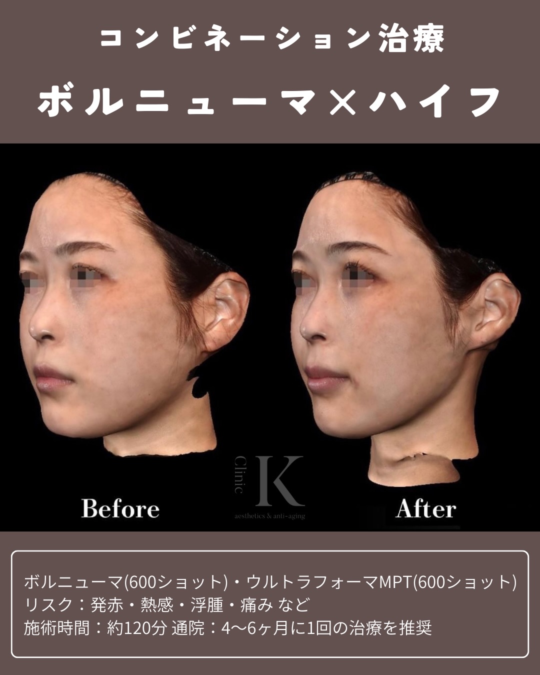 VOLNEWMER症例写真